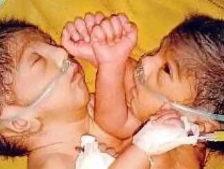 Two children born in the Sagar, connected by one heart, became an inexplicable puzzle for the doctors of Bhopal AIIMS