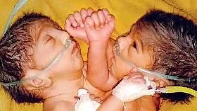 Two children born in the Sagar, connected by one heart, became an inexplicable puzzle for the doctors of Bhopal AIIMS